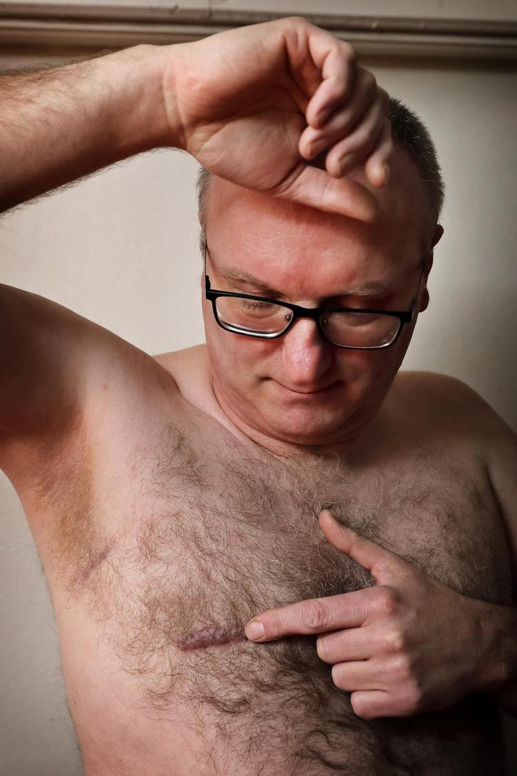 Andreas Bernth, 49 år, blev opereret for brystkræft for et år siden.  