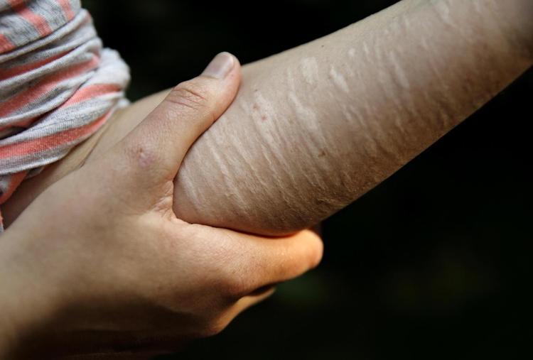 At skære i sig selv er den mest udbredte form for selvskade blandt danske unge, men langtfra den eneste form.  