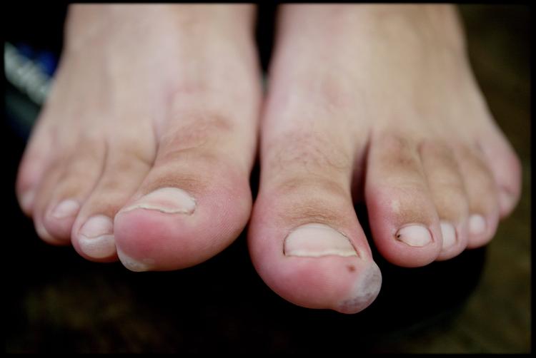 Vask blærer og vabler i sæbevand, men undgå at prikke hul, medmindre blæren er meget spændt. Huden beskytter nemlig det underliggende sår. Arkivfoto: Linda Johansen