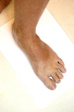 Neglesvamp, som en af ugens læsere spørger til, er et omfattende emne. Her er det vigtigt, at man spørger sig selv, hvor meget svampen påvirker en. Foto: Andreas Haubjerg