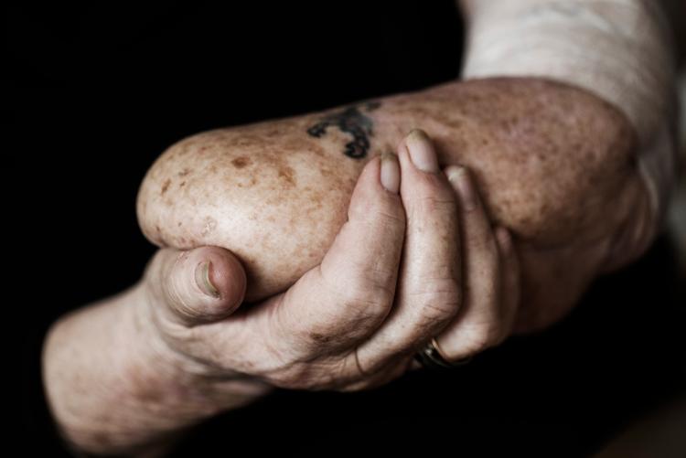 Sonja Løndahl fik amputeret venstre hånd for 25 år siden efter en blodprop. Hun har været plaget af smerter lige siden. 