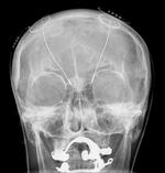 Et forskerhold er blevet klogere på, hvad der sker i hjernen hos patienter med Parkinsons sygdom, når de tænder for hjernepacemakeren og de voldsomme rystelser forsvinder. På dette røntgenbillede kan man se, hvor dybt elektroderne er placeret i hjernen. Foto: Hellerhoff. 