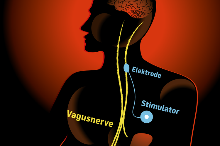 Gennembrud. Det er lykkedes et fransk forskerhold at få en patient ud af en grøntsagslignende tilstand og at genvinde en smule af bevidstheden ved at sætte strøm til vagusnerven. Det vækker håb om en bedre behandling af vegetative patienter i fremtiden. Illustration: Claus Nørregaard 
