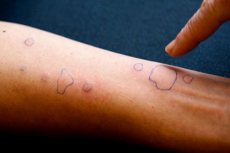 Alle Folketingets partier er enige om at øge midlerne til at styrke indsatsen for at forebygge allergi.
   