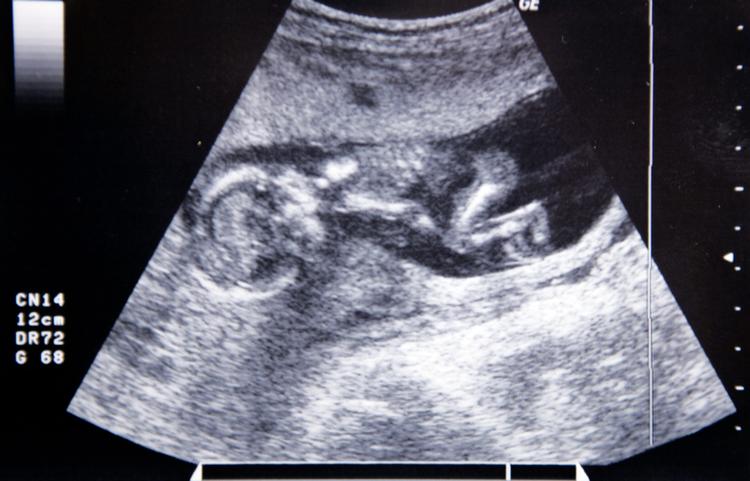 Hvis en nybagt mor eller far får en fødselsdepression, bliver 40 procent af børnene mærket langt ind i barndommen. Derfor er hurtig hjælp afgørende.  