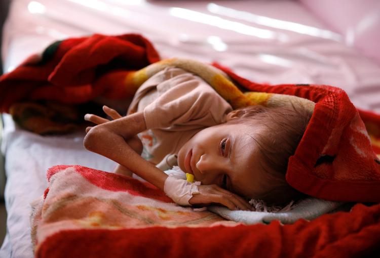 ARKIVFOTO. Foto fra januar 2016 af en udsultet barn, der venter på behandling på et hospital i Sanaa, Yemen.  