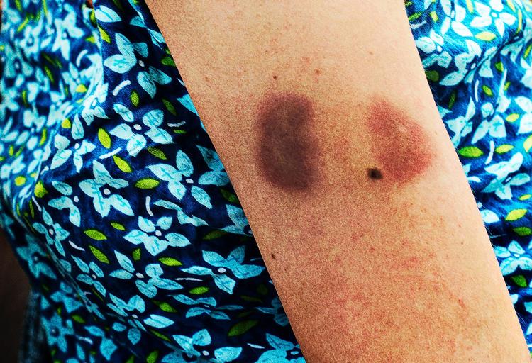 I november rettede EU's ekspertenhed Grevio, der varetager voldsramte kvinders interesser, en hård kritik af Danmark, fordi så mange voldsramte kvinder bliver afvist, når de søger hjælp hos krisecentrene. 