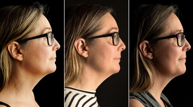 Bagsiden vil gerne medgive, at det er svært at se på foto, men på første billede til venstre taget inden eksperimentet, er der 24 cm halsflæsk. På billedet i midten fra 23. april er der 23 cm halsflæsk og på billedet til højre fra i forgårs er der kun 22 cm flæsk. Foto: Jens Dresling, Finn Frandsen og Peter Hove Olesen 