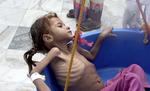En lille, underernæret pige bliver vejet i et FN-drevet sundhedscenter i Aslam, Yemen.


    Hammadi Issa/AP