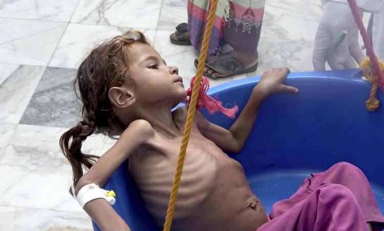 En lille, underernæret pige bliver vejet i et FN-drevet sundhedscenter i Aslam, Yemen.


    Hammadi Issa/AP