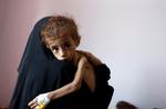 Ifølge FN står verden med konflikten i Yemen over for den værste sultkatatstrofe i 100 år. Inden for de næste tre måneder kan 12-13 millioner mennesker være i risiko for at dø af sult. Khaled Abdullah/Ritzau Scanpix