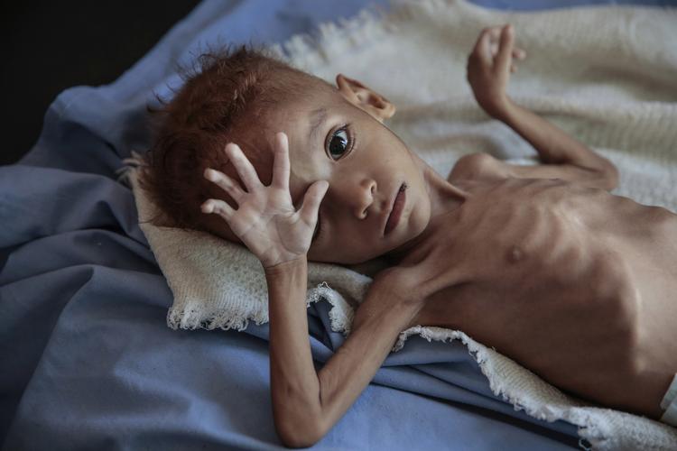 Den saudisk-ledede koalitions angreb på Yemen har kostet civilbefolkningen dyrt. Her ses et underernæret barn på en klinik i Yemen. Hani Mohammed/AP