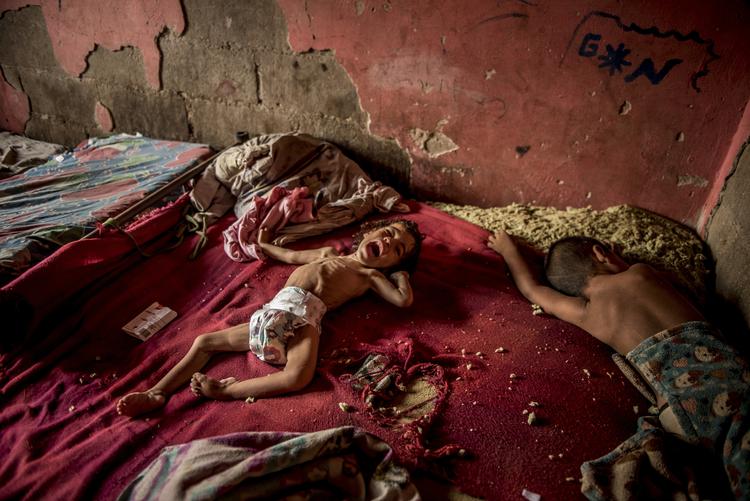 
    Den to år gamle Anailin (tv) fra Isla de Toas i Venezuela lider af alvorlig underernæring.  Foto: Meridith Kohut/Ritzau Scanpix