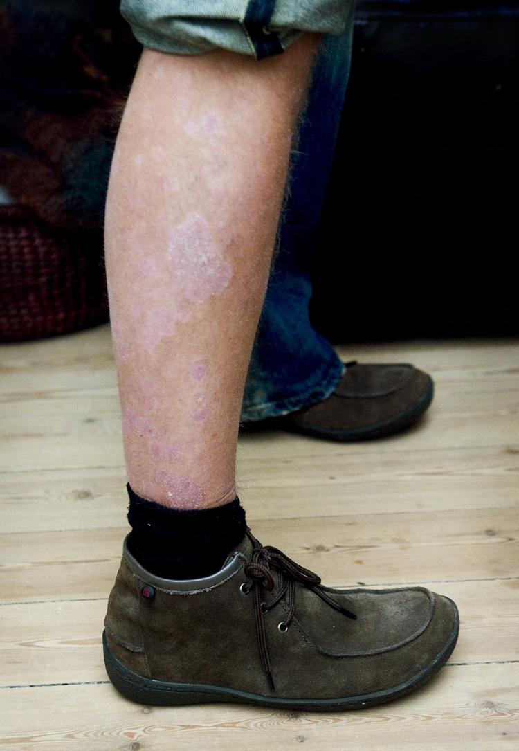 
    Mennesker med hudsygdommen psoriasis kan måske have gavn af at smøre de angrebne steder i kæmpenatlysolie eller en anden form for olie.
   Arkivfoto Thomas Lekfeldt
