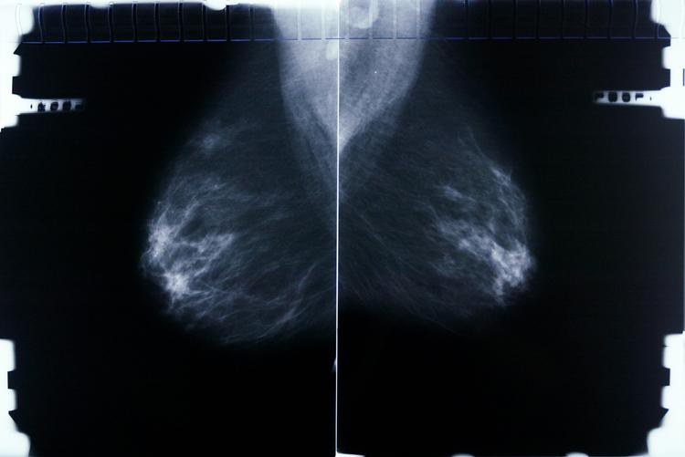 Det er mammografier - altså røntgenbilleder af brysterne - som computere har lært at undersøge for kræft. I Danmark undersøger to radiologer uafhængigt af hinanden et mammografi for at sikre korrekte diagnoser. Arkivfoto Miriam Dalsgaard