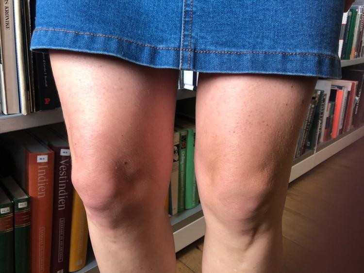Man kan ikke se på sine knæ, at der ikke er betalt forsikring for dem.. Foto: Bagsiden 