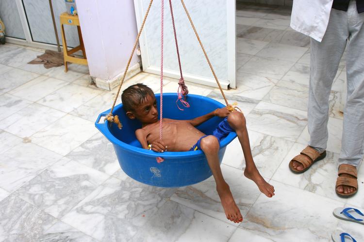 Lægerne vejer den underernærede dreng Hassan Merzam Muhammad på et hospital i Hajjah-provinsen i Yemen.  Foto: Stringer/Ritzau Scanpix