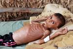 Drengen Hassan Merzam Muhammad fra Yemen er et billede på alt det, FN advarer om: Den værste hungerkatastrofe, verden har oplevet i årtier. Foto: Stringer/Ritzau Scanpix