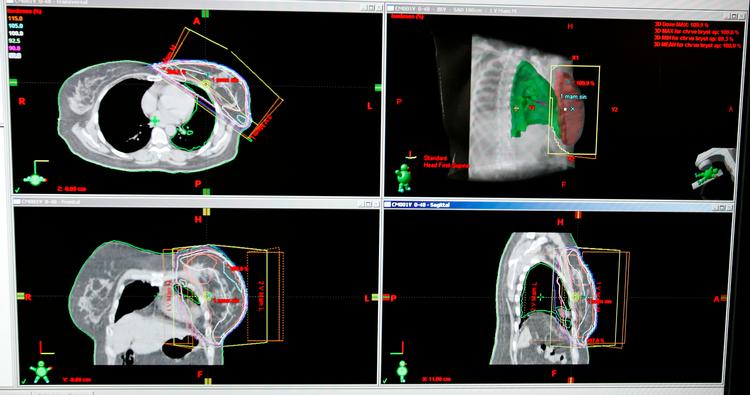 Som følge af corona bliver for få tjekket for Kræft, det betyder at folk kommer senere i gang med behandling for eksempel med stråler, som her vises på røntgenbillede på Rigshospitalet i København. Foto: Jens Dresling/POLFOTO
