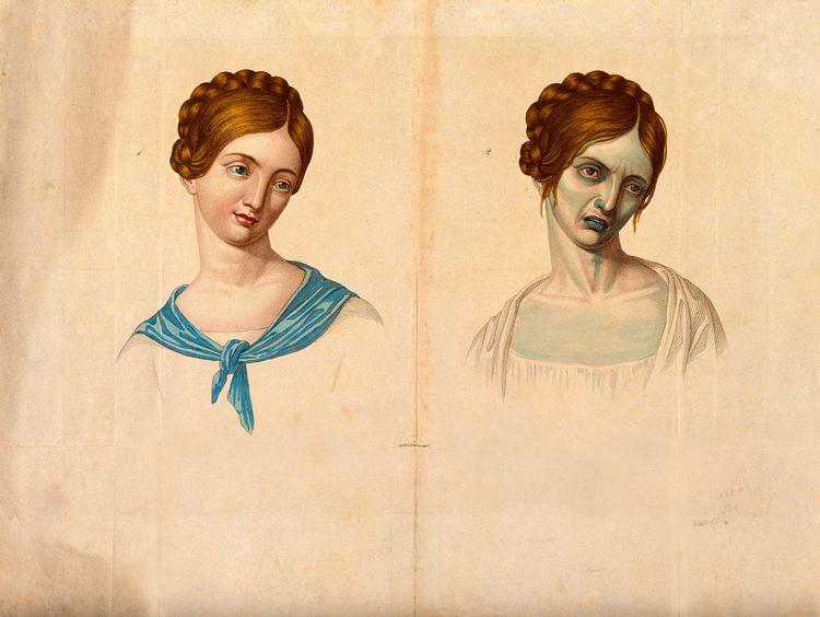 Cholera-young woman from Vienna s3_V0010000_V0010485