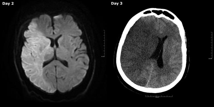 Billedet skal ses som, at fødderne på patienten peger nedad. På venstre billede ses en lige midtlinjeforskydning, hvor de to hjernehalvdele er ligeligt fordelt. På højre billede er forskydningen skubbet mod venstre side af hjernen, hvilket skyldes hævelse. Scanninger Research Square