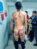 En afghansk mand undersøges i Bosnien-Hercegovina efter at være blevet mishandlet af kroatiske grænsevagter. Billedet er taget af Dansk Flygtningehjælp i 2020. Foto: Uncredited/Ritzau Scanpix