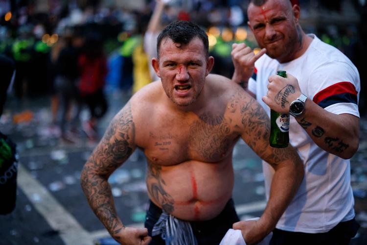 Allerede inden finalekampen England-Italien var der ballade, her på Trafalgar Square, hvor en fan poserer efter at være  blevet ramt af en flyvende flaske. Foto: Tolga Akmen/Ritzau Scanpix