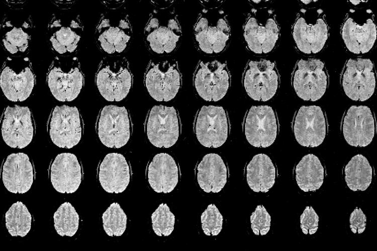 Et studie har vist høj aktivitet af gamma-bølger 15 sekunder inden og efter et dødsfald. Scanningerne på billedet er ikke fra det omtalte studie. Foto: Jens Hartmann