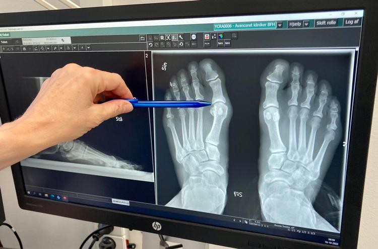 Skæve tæer er måske ikke det kønneste i verden. Men jeg har efter sigende smukke ledspalter. Foto: Per Munch