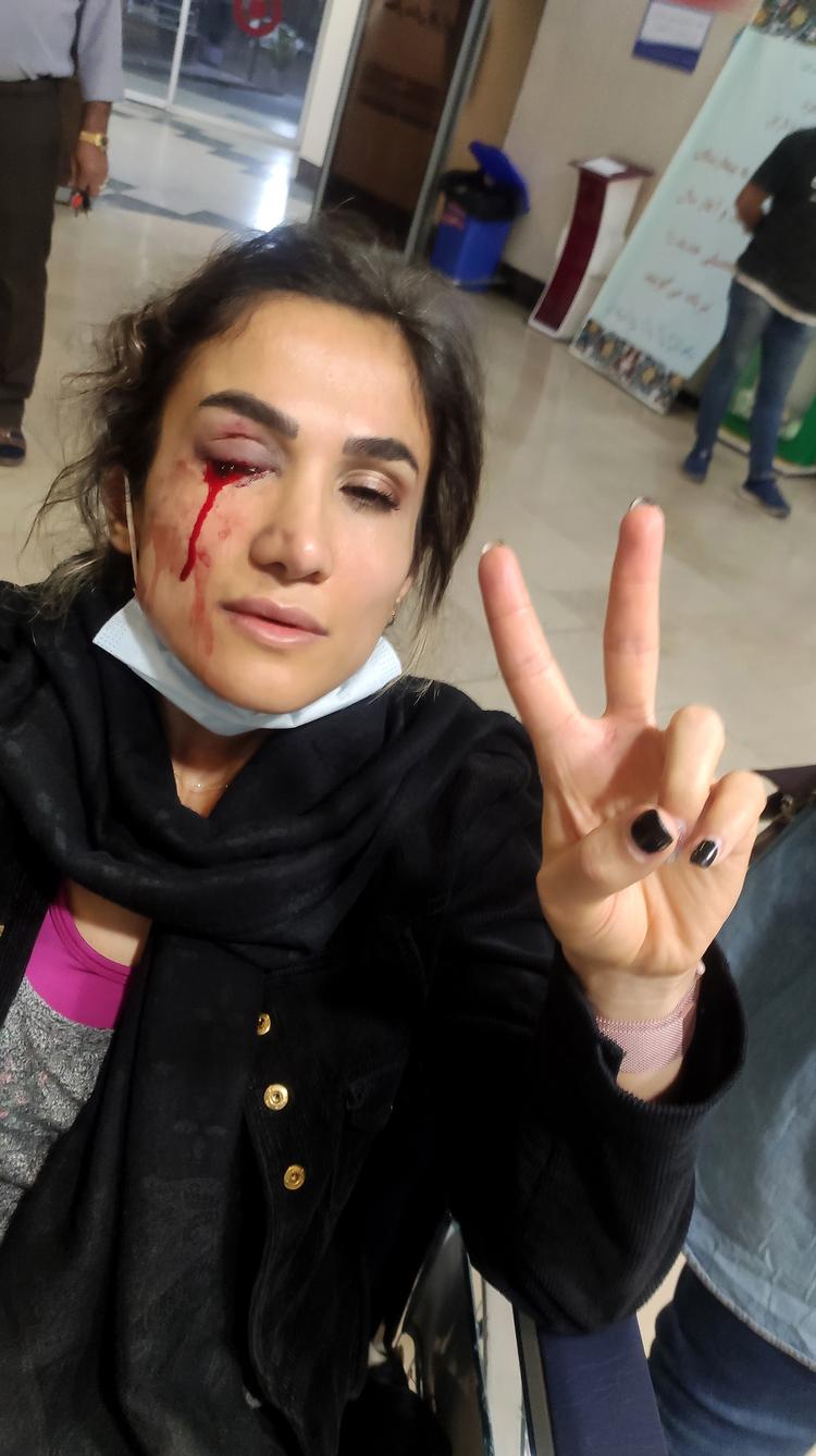 Mersedeh Shahinkar, der lørdag modtager Politikens Firhedspris, efter at iranske agenter i oktober 2022 havde skudt hende i øjet. Hun lagde dette foto på sociale medier for at vise, hvad præstestyret gør ved sine modstandere. Privatfoto.  Foto: Thomas Borberg