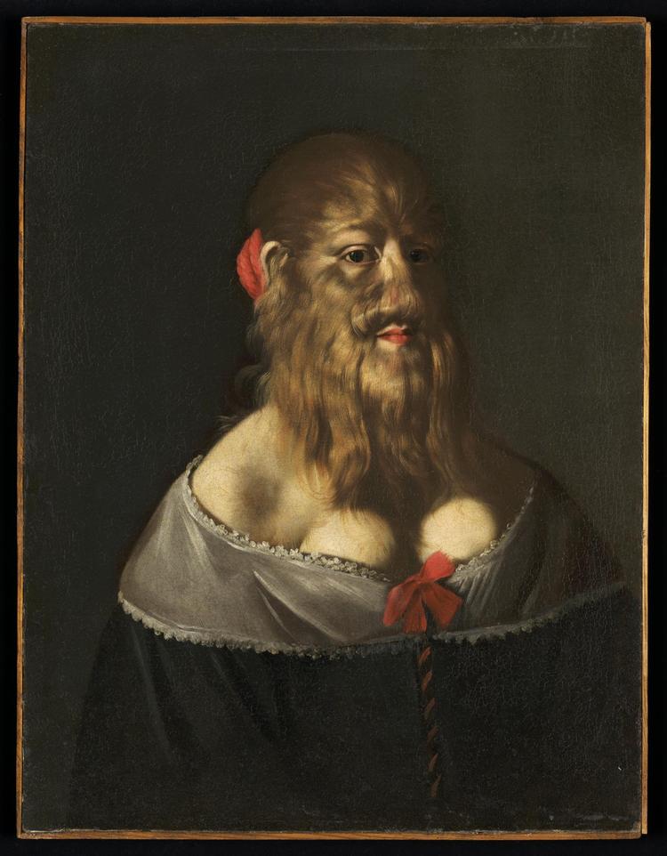 Barbara van Beck led af det, vi i dag kalder hypertrichosis eller Ambras syndrom. 