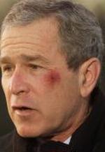 Præsident Bush besvimede efter at have spist pretzels. Det resulterede i denne skramme. - Arkivfoto: AP 