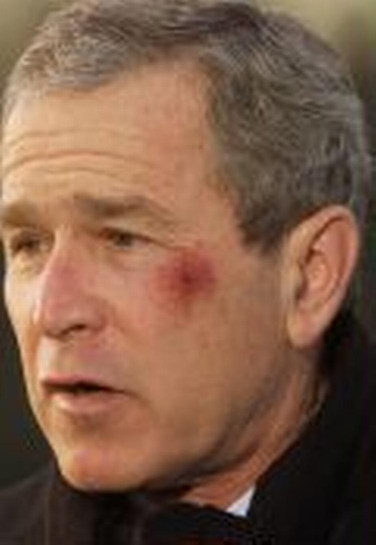 Præsident Bush besvimede efter at have spist pretzels. Det resulterede i denne skramme. - Arkivfoto: AP 
