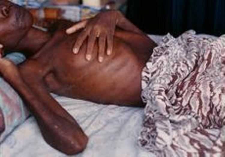 Hiv/aids er en dræber, der breder sig hurtigst i Afrika, Østeuropa og Asien. - Foto: Jesper Strudsholm 