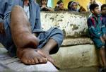 55-årige Egypter Mahmoud Said Khader hviler sit ben, der er misdannet på grund af elefantiasis. På verdensplan er over en milliard mennesker i fare for at blive smittet. Nye partnerskaber arbejder for at bekæmpe sygdommen.   Foto: 