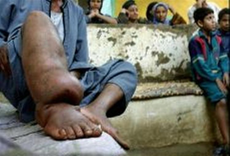 55-årige Egypter Mahmoud Said Khader hviler sit ben, der er misdannet på grund af elefantiasis. På verdensplan er over en milliard mennesker i fare for at blive smittet. Nye partnerskaber arbejder for at bekæmpe sygdommen.   Foto: 