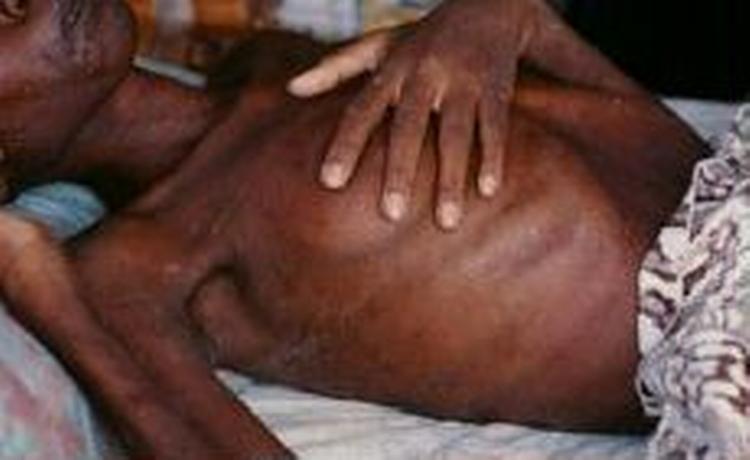 Aids udgør især et problem i Afrika syd for Sahara. - Arkivfoto: Jesper Strudsholm 