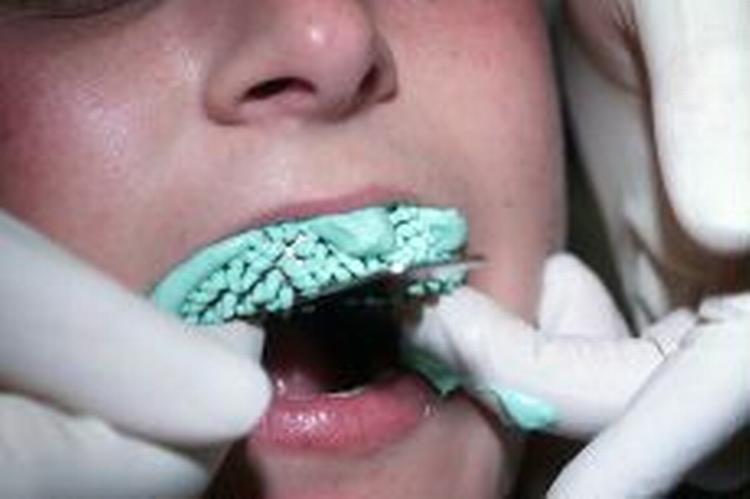 Blegningen foregår ved at tænderne bliver smurt ind i gele, der indeholder brintoverilte. - Arkivfoto: Jens Dresling 