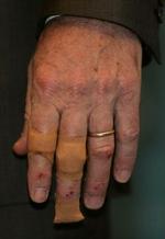 Præsidenten Bush har fået plaster på hånden. - Foto: AP 