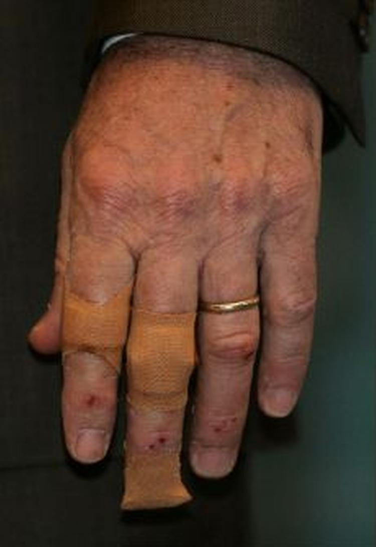 Præsidenten Bush har fået plaster på hånden. - Foto: AP 