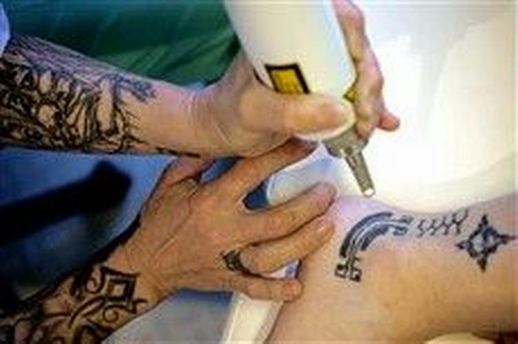 Stadig flere fortryder, at de er blevet tatoveret, eller indser, at kropsdekorationen ikke passer til deres nuværende liv og job. Hos Laser Clinique Copenhagen i København fjernes tatoveringer.   Foto: Thomas Borberg 