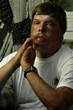 Matthew Teffelteller fra Knoxville er en af dem, der kunne komme i betragtning til en ansigtstransplantation. Men han vil slet ikke. - Foto: AP 