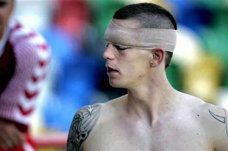 Daniel Agger fik en flænge over det ene øje i kampen mod Holland. - Foto: Thomas Wilmann 