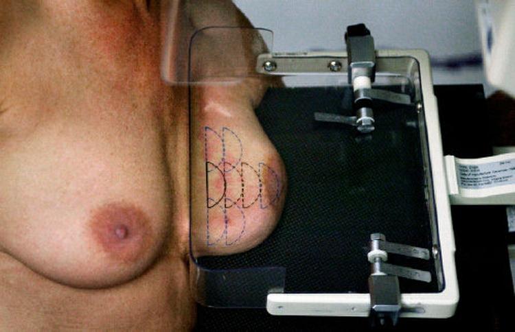 Ved mammografiundersøgelser kan selv ganske små kræftsvulster afsløres. Men nogle kvinder får også at vide, at der er noget galt, selv om det ikke er tilfældet. Og det belaster kvinderne stærkt, viser ny forskning. 