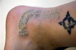 Tatovering, der er delvist fjernet med laserbehandling. 