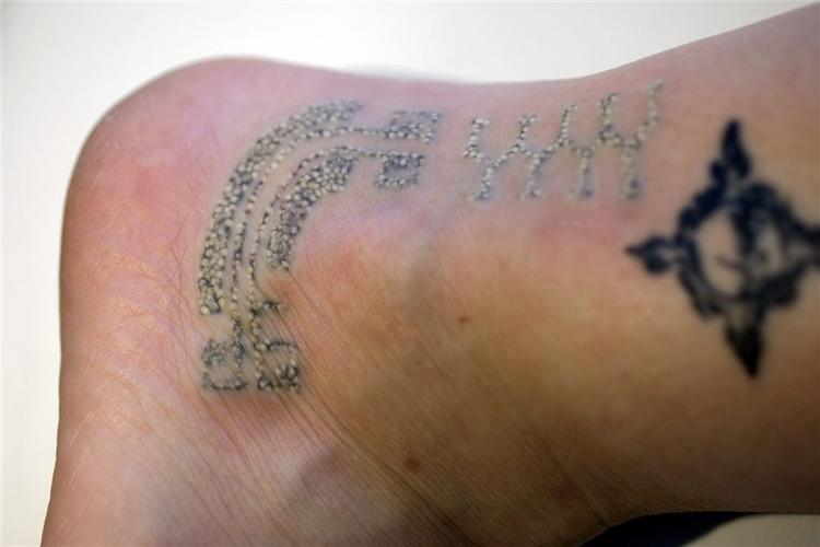 Tatovering, der er delvist fjernet med laserbehandling. 