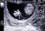 Ny forskning sætter spørgsmålstegn ved, hvor mange hormoner, der er gavnligt ved kunstig befrugtning. 
