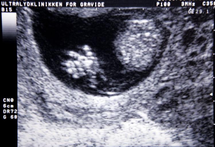 Ny forskning sætter spørgsmålstegn ved, hvor mange hormoner, der er gavnligt ved kunstig befrugtning. 