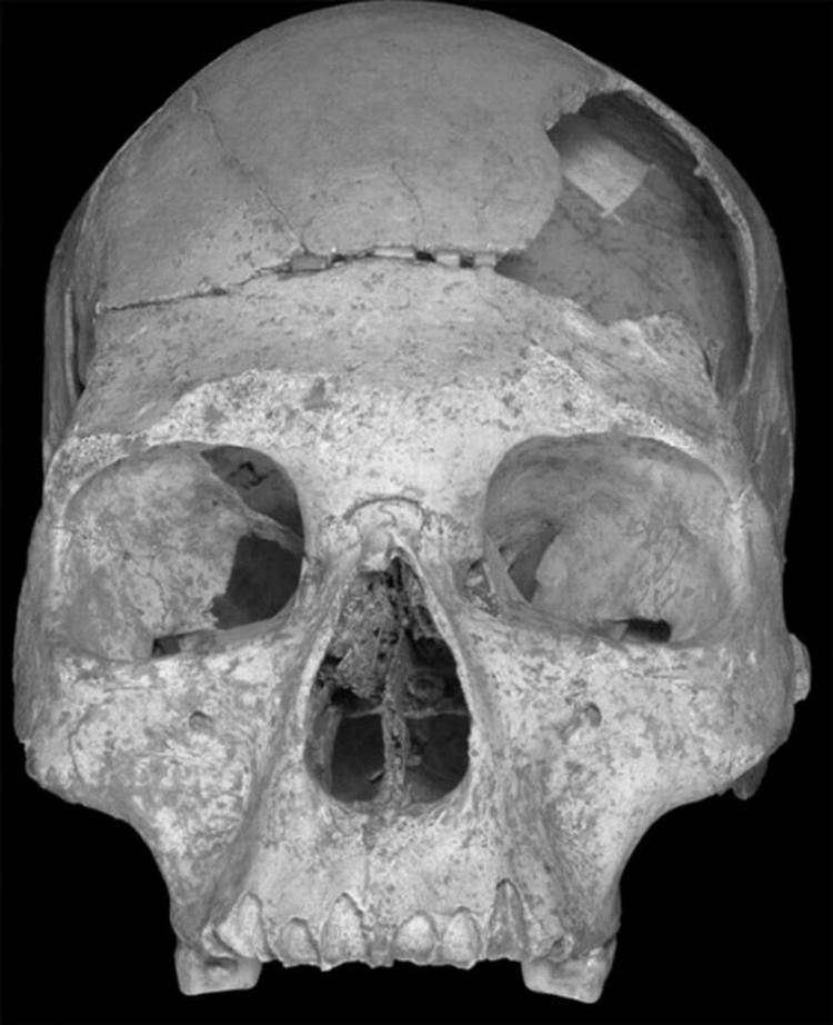 Dette kranium fra Pestera cu Oase i Rumænien viser ifølge amerikansk forsker tegn på, at det er en blanding af Homo Sapiens og neanderthalere. 
