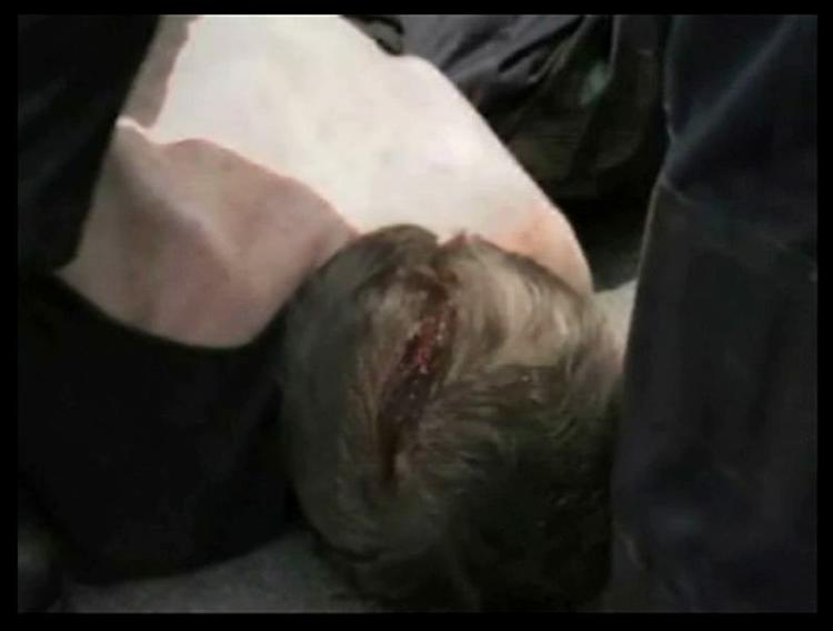 Hvis det var et forsætligt slag med politistav, der lavede denne flænge i baghovedet på en demonstrant i aftes, er det en overtrædelse af stavreglementet, siger statsadvokaten. 